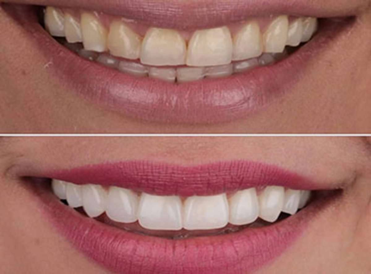 Margaret W. - Seville - Smile Design (20 Veneers)