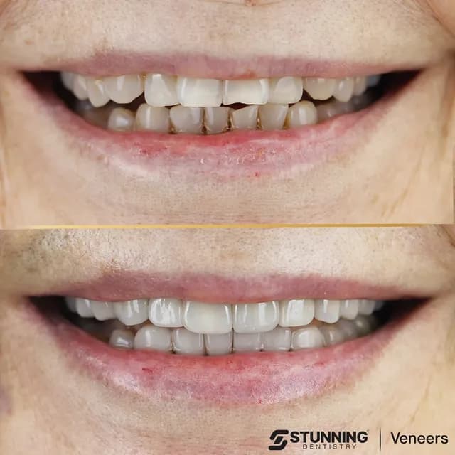 Smile Makeover, USA – photo 4