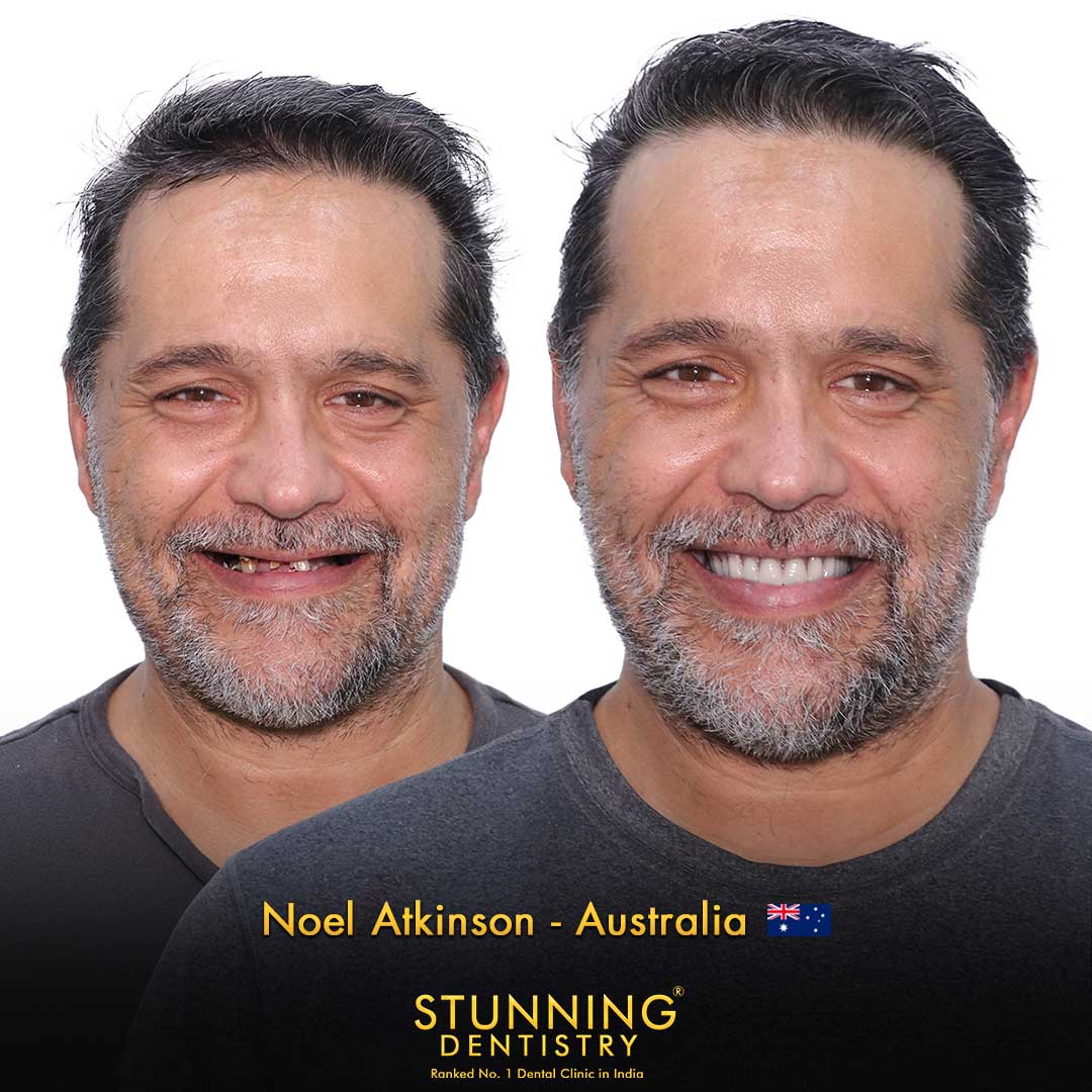 Porcelain Veneers - photo 1