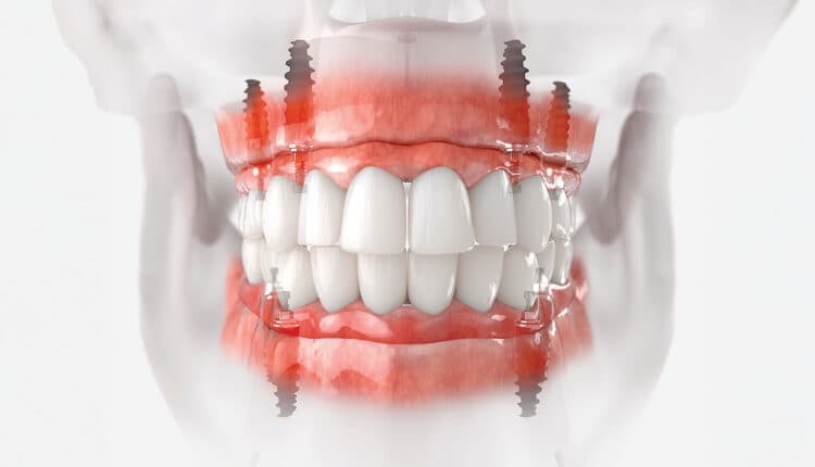 The 35 Ncm Insertion Torque Threshold, The Honest Gate <a id="torque-threshold"></a>