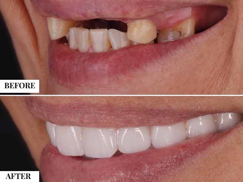 For Spanish Patients: Travel, Recovery, Home Dentist <a id="spanish-logistics"></a>