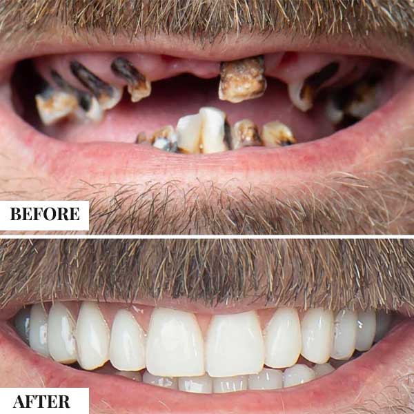 All-on-4 dental implants treatment case at Stunning Dentistry