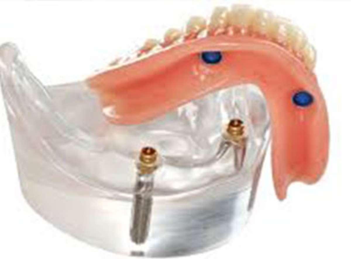 The Hidden Cost of Dentures