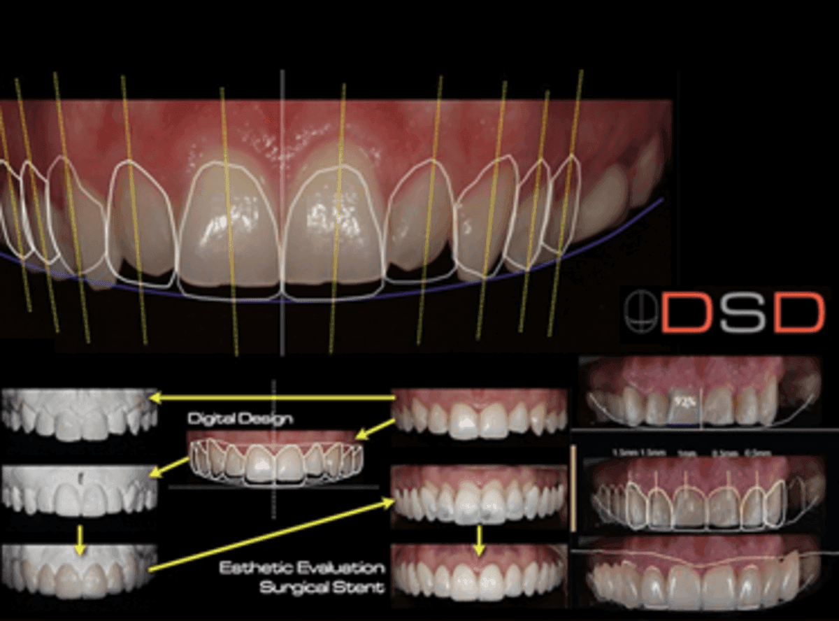 Smile Design & Veneer Cases (5-7 Days)
