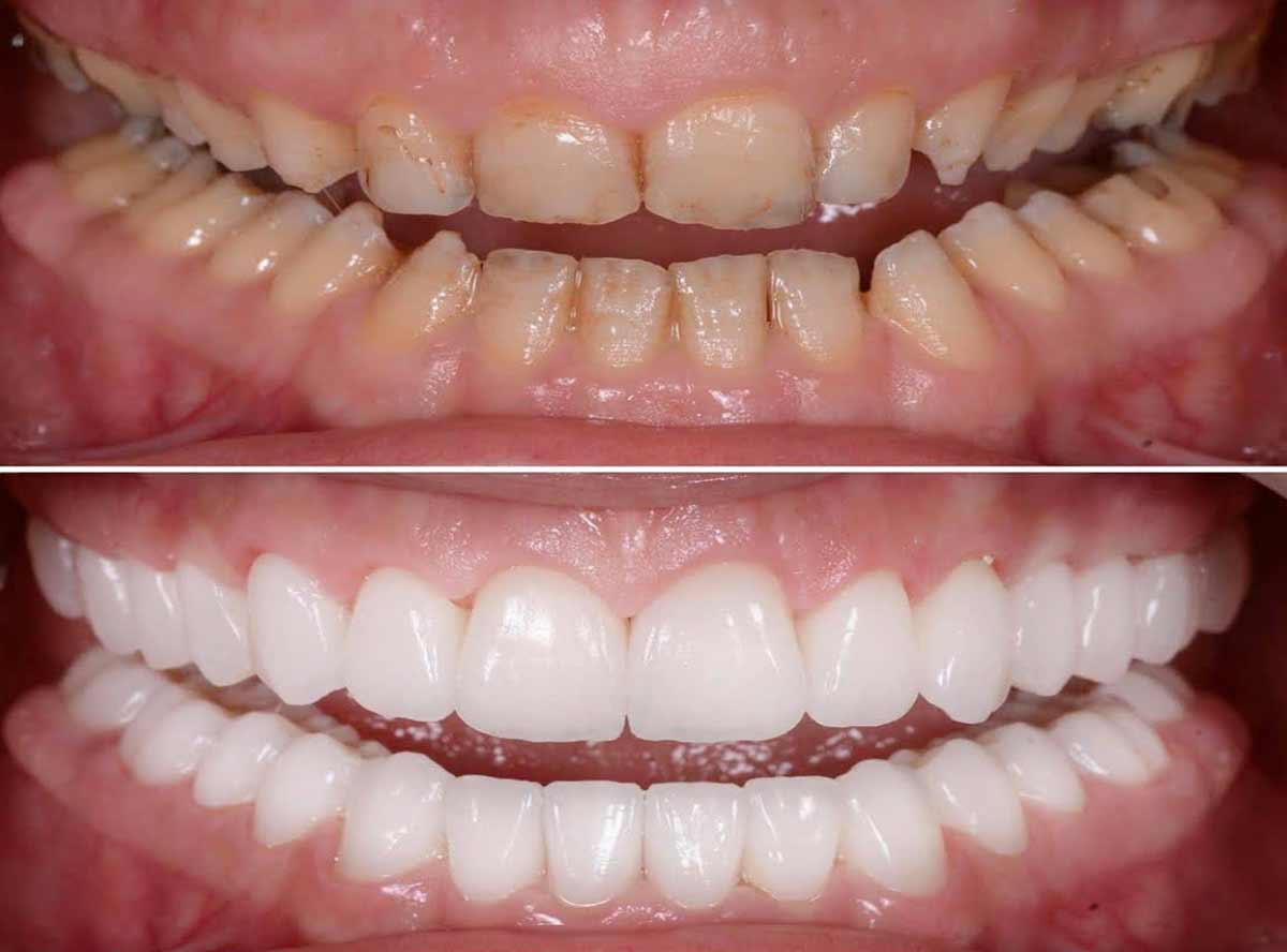 Full mouth rehabilitation patient at Stunning Dentistry New Delhi