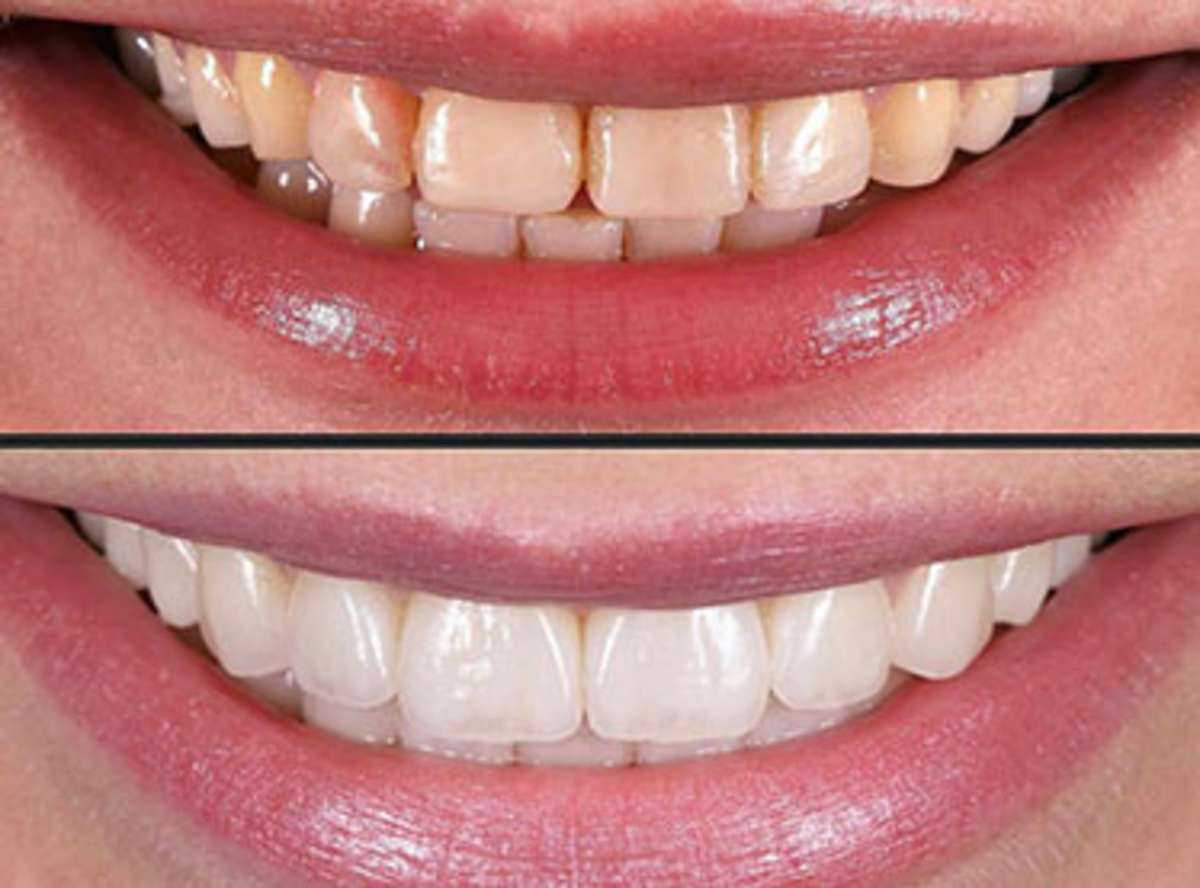 Why We Decline to Up-Sell Veneer Counts <a id="no-upsell"></a>