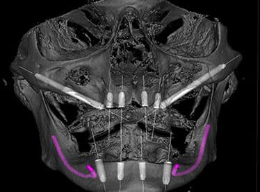 Zygomatic Implant Cases (10-14 Days)