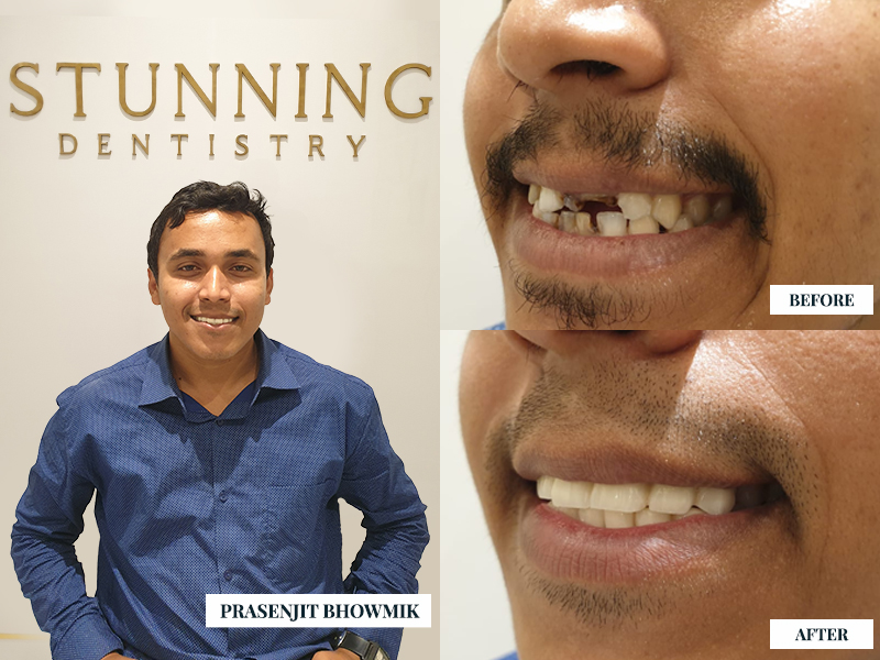 Dental Implants - photo 4