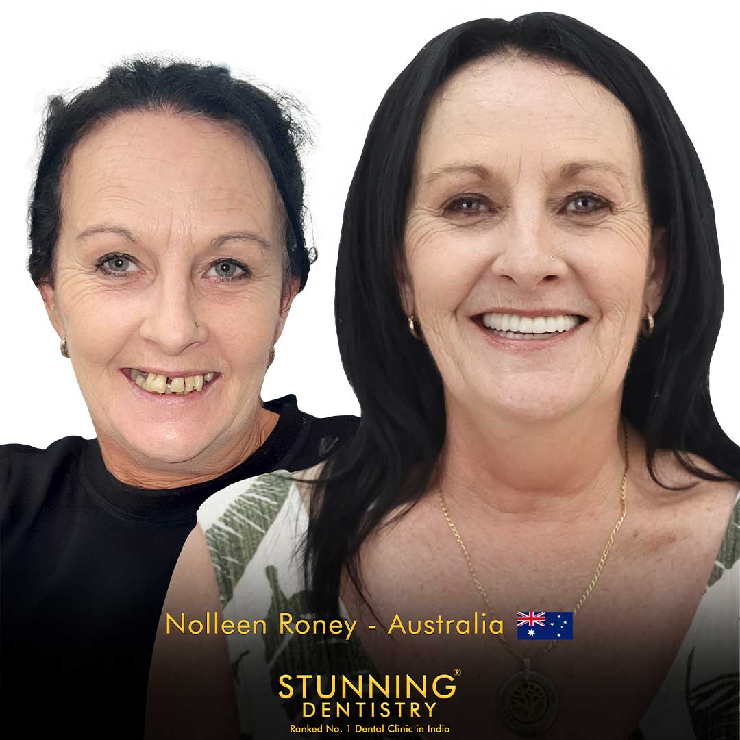 Cosmetic veneers result