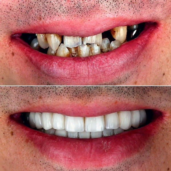Full Mouth Rehabilitation - photo 2