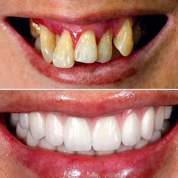 Full Mouth Rehabilitation - photo 2