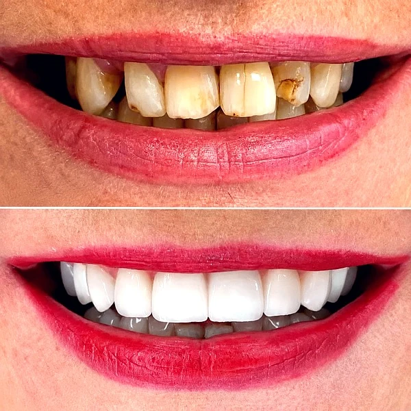 Smile Design (Veneers) - photo 2