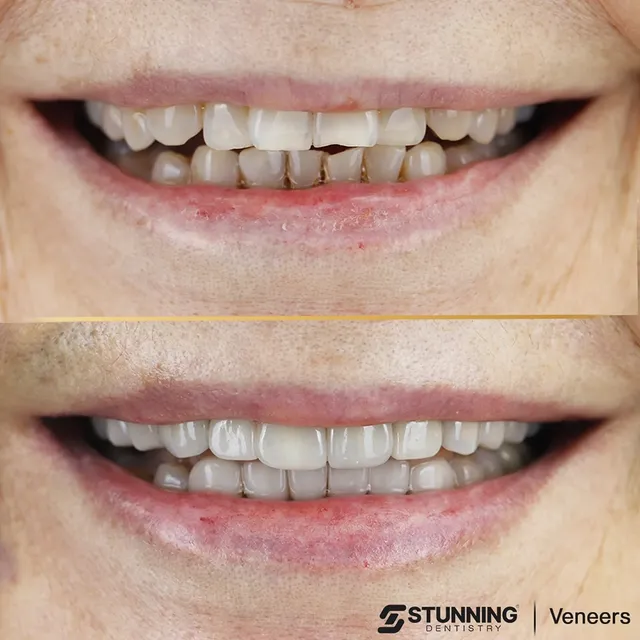 Smile Makeover, USA – photo 4