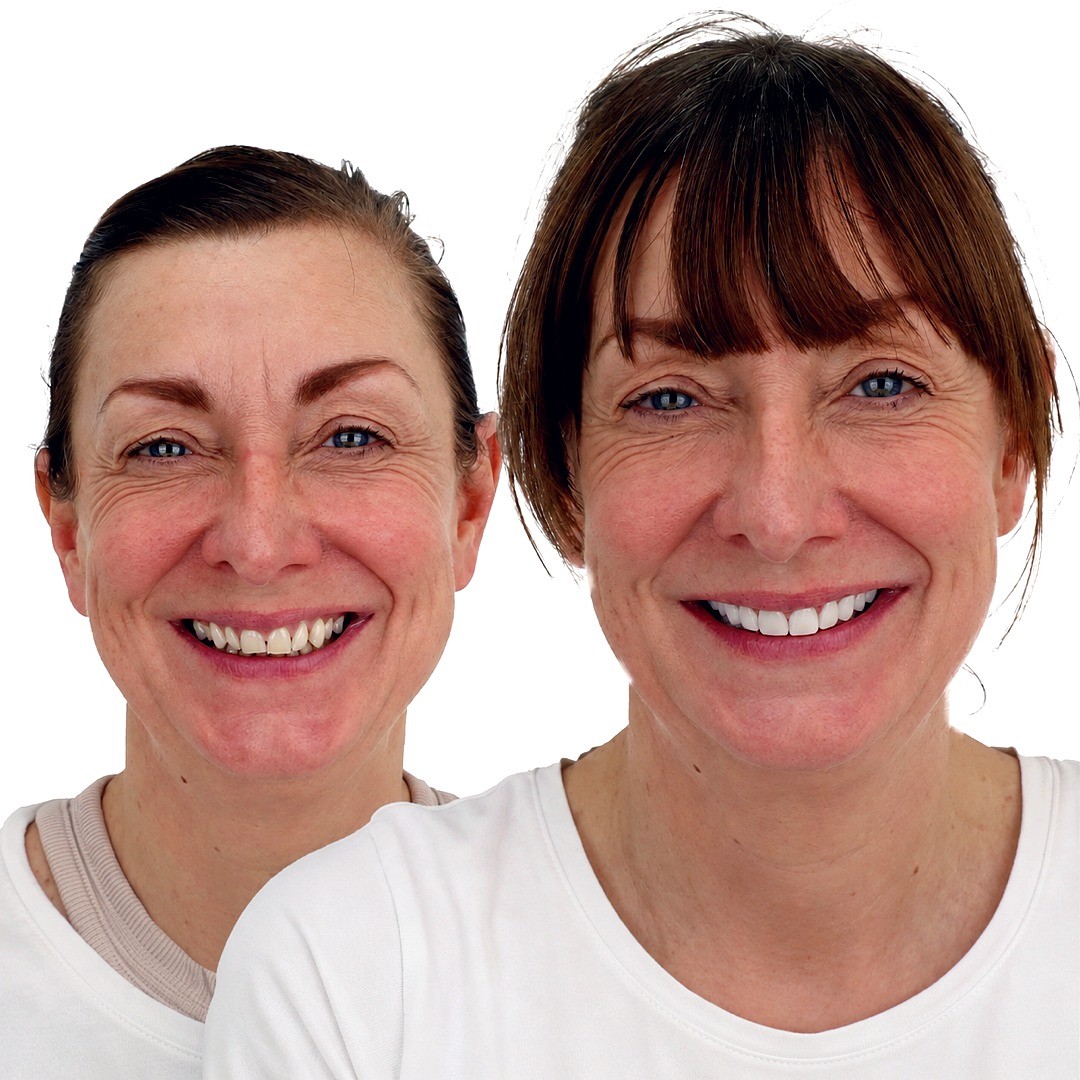 Smile Design (Veneers) - photo 1