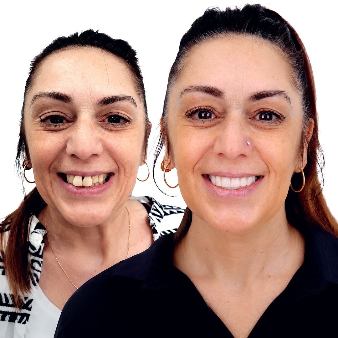 Full Mouth Rehabilitation - photo 1