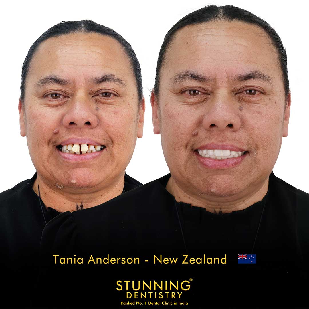 Smile Makeover - photo 1