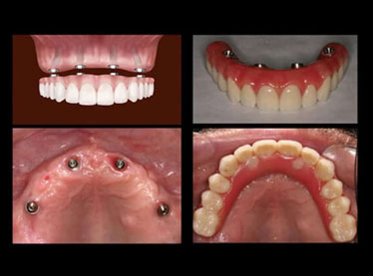 Materials: Fixtures, Framework, and Teeth <a id="materials"></a>