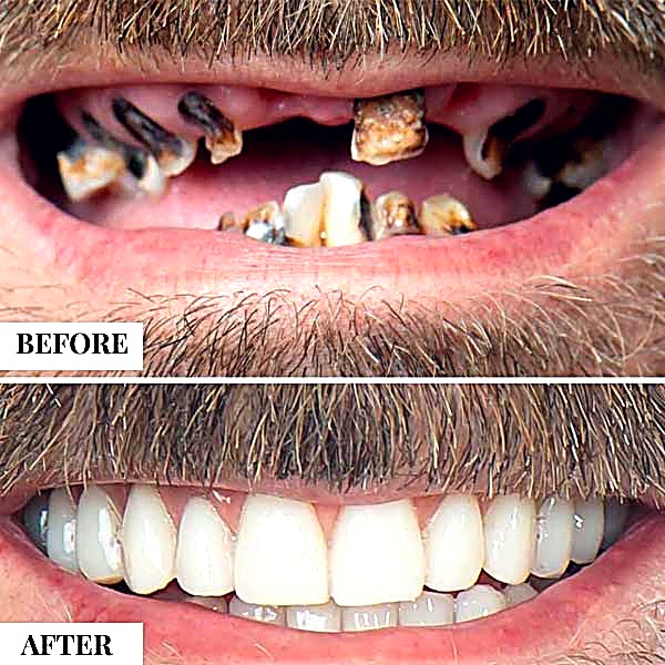 All-on-4 dental implants before and after