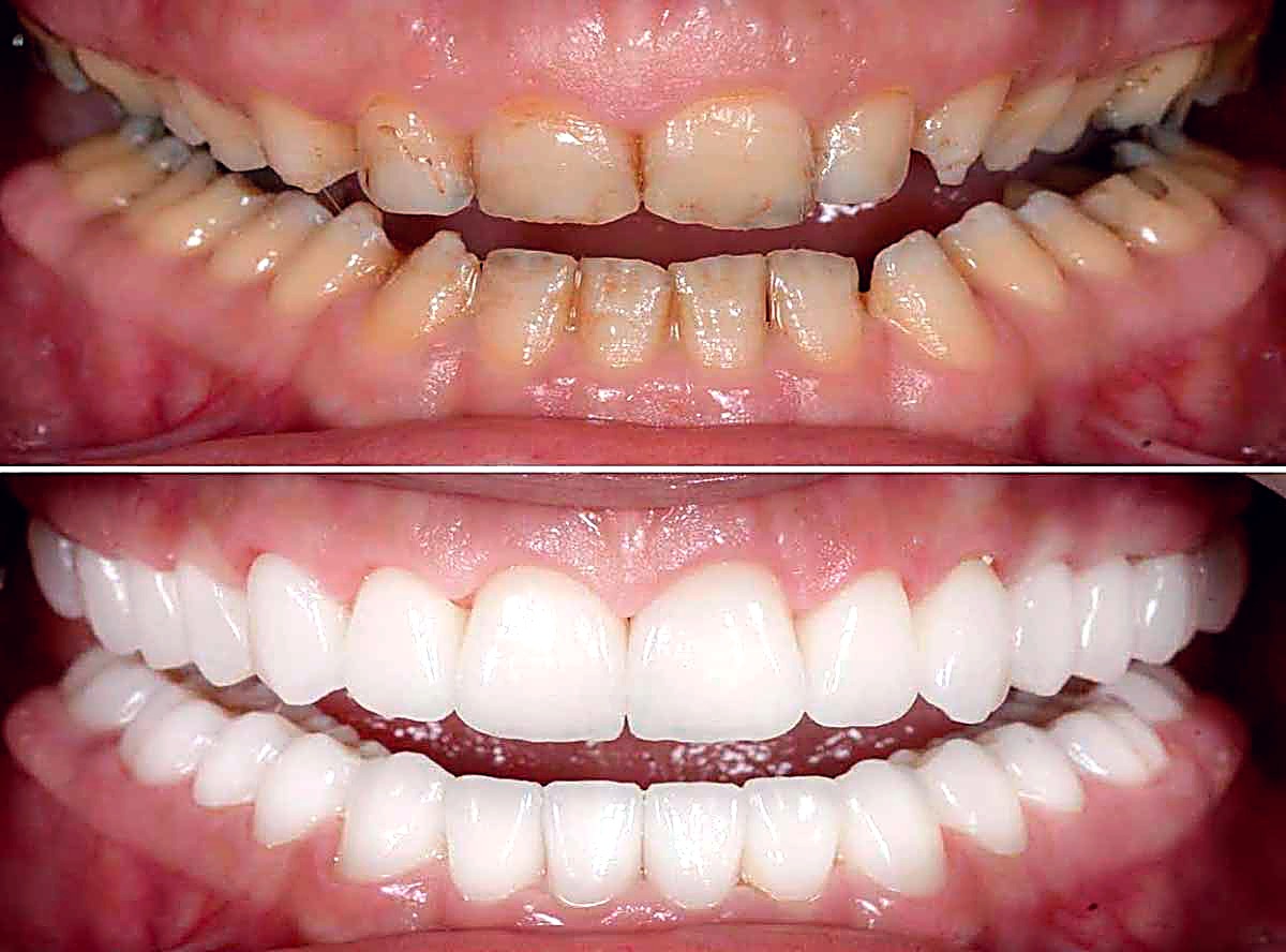 Full mouth rehabilitation before and after