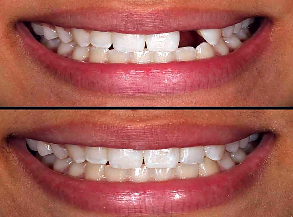 Same-day implant teeth before and after