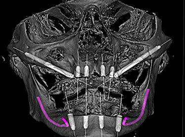 Zygomatic implant 3D CT planning